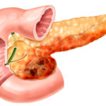 Мезим при панкреатите поджелудочной железы